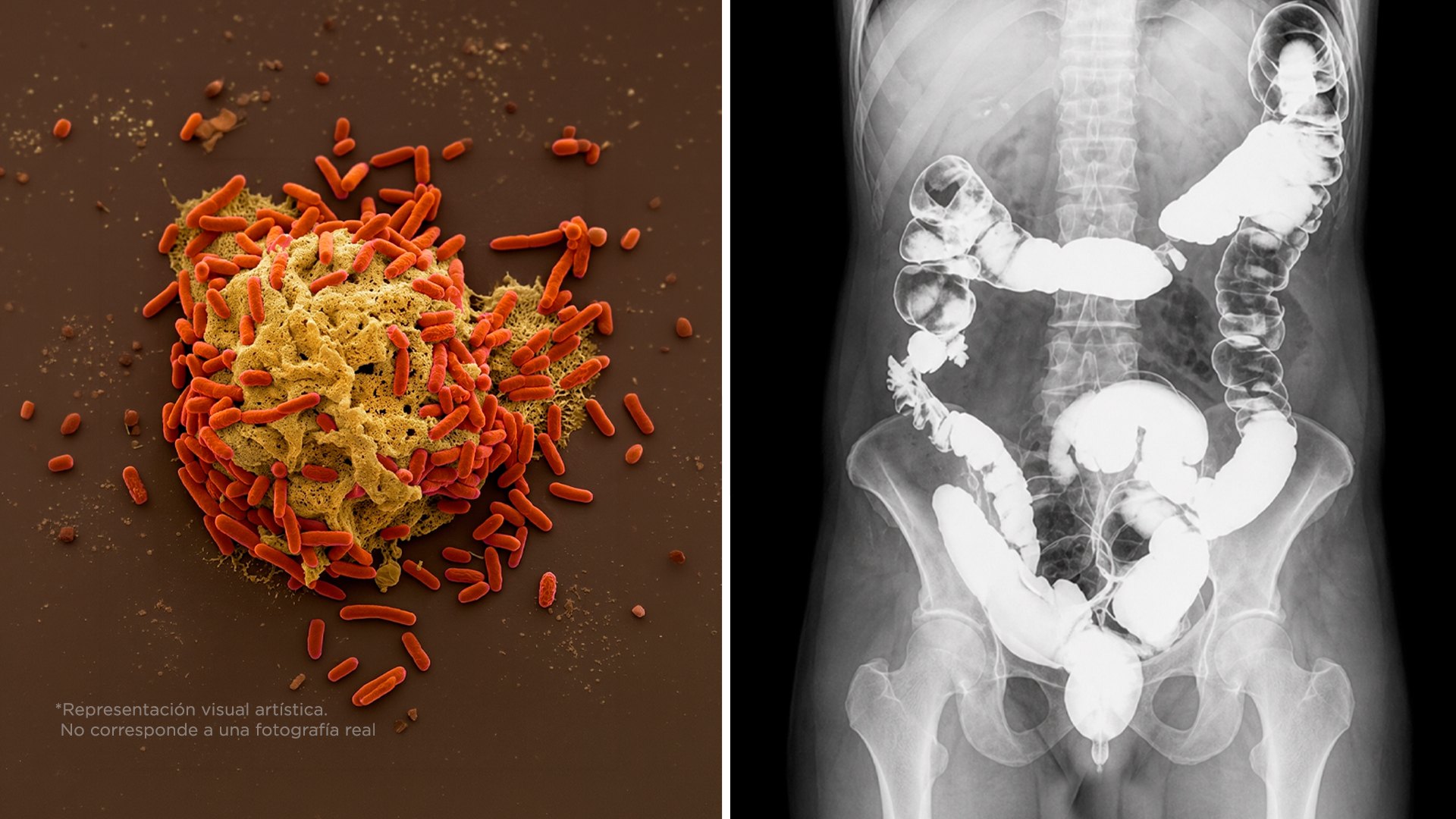 ¿Por qué cada vez más jóvenes tienen cáncer de colon?